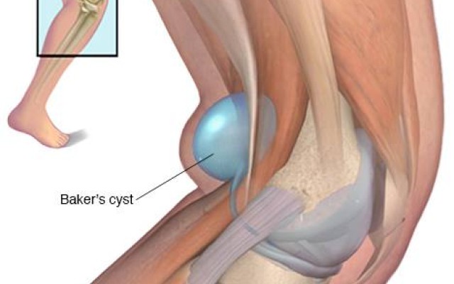 Baker's Cyst of The Knee