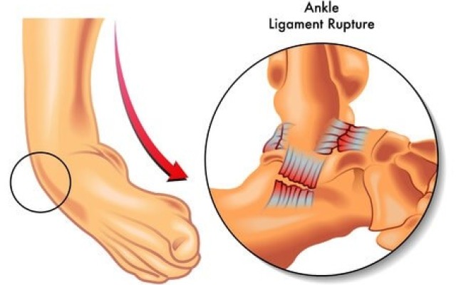 Chronic Ankle Instability