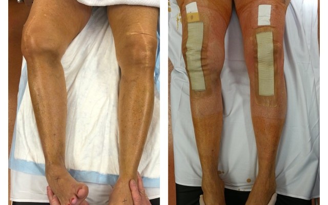 Navigated Medial Epicondylar Slide Osteotomy (TKR)