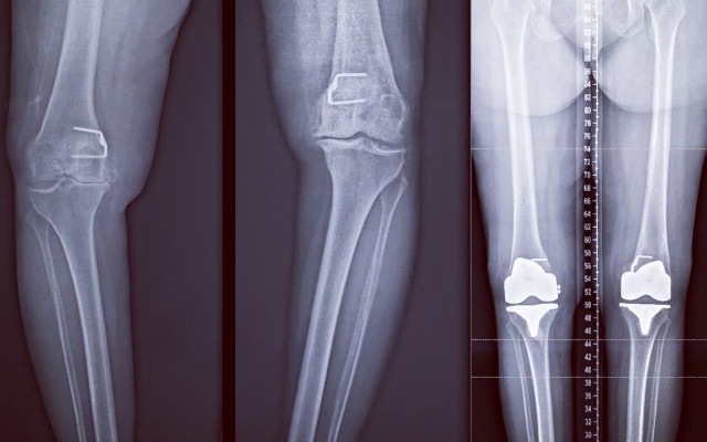 Bilateral (2) Hip and Knee Replacements